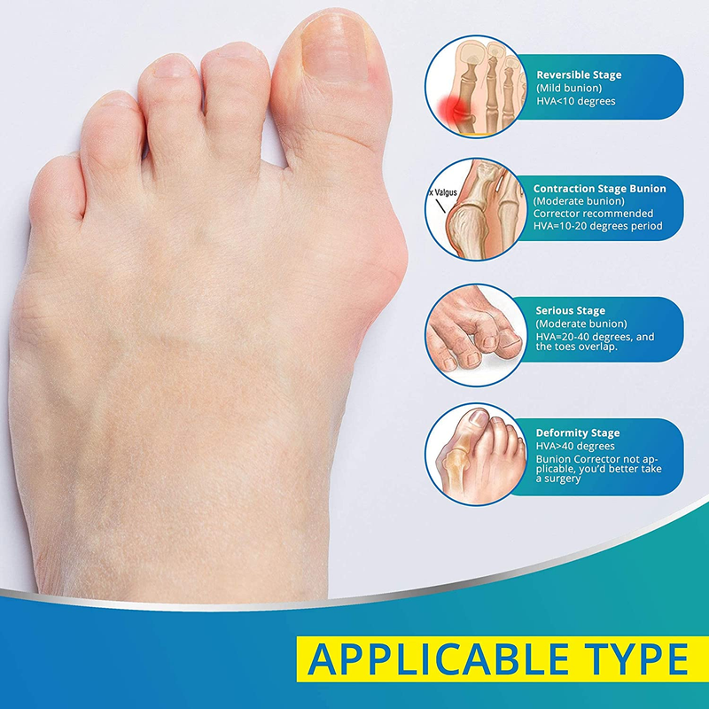 Vicorrect Bunion Corrector & Bunion Toe Separators, Orthopedic Bunion Splint for Big Toe Pain Relief and Toe Straightening, Hallux Valgus Brace for Day/Night Support